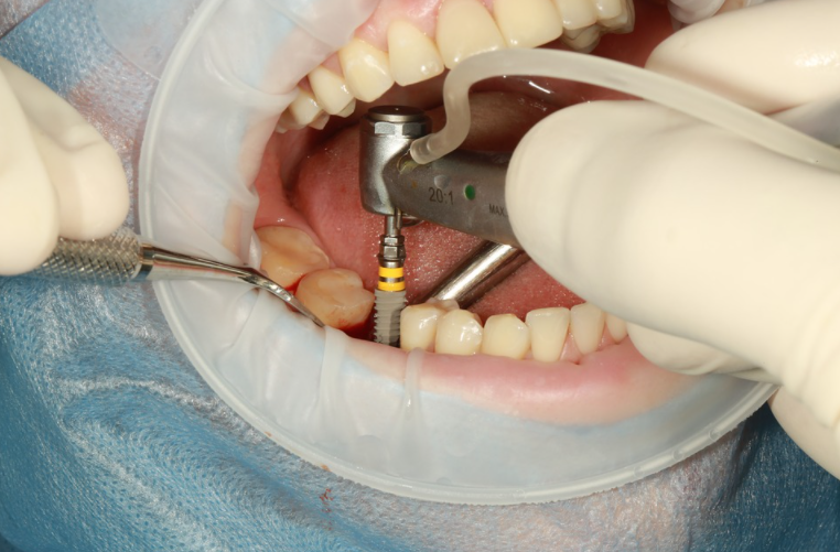 Procedures Taken in a Dental Implant